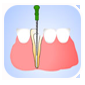 root canal treatment